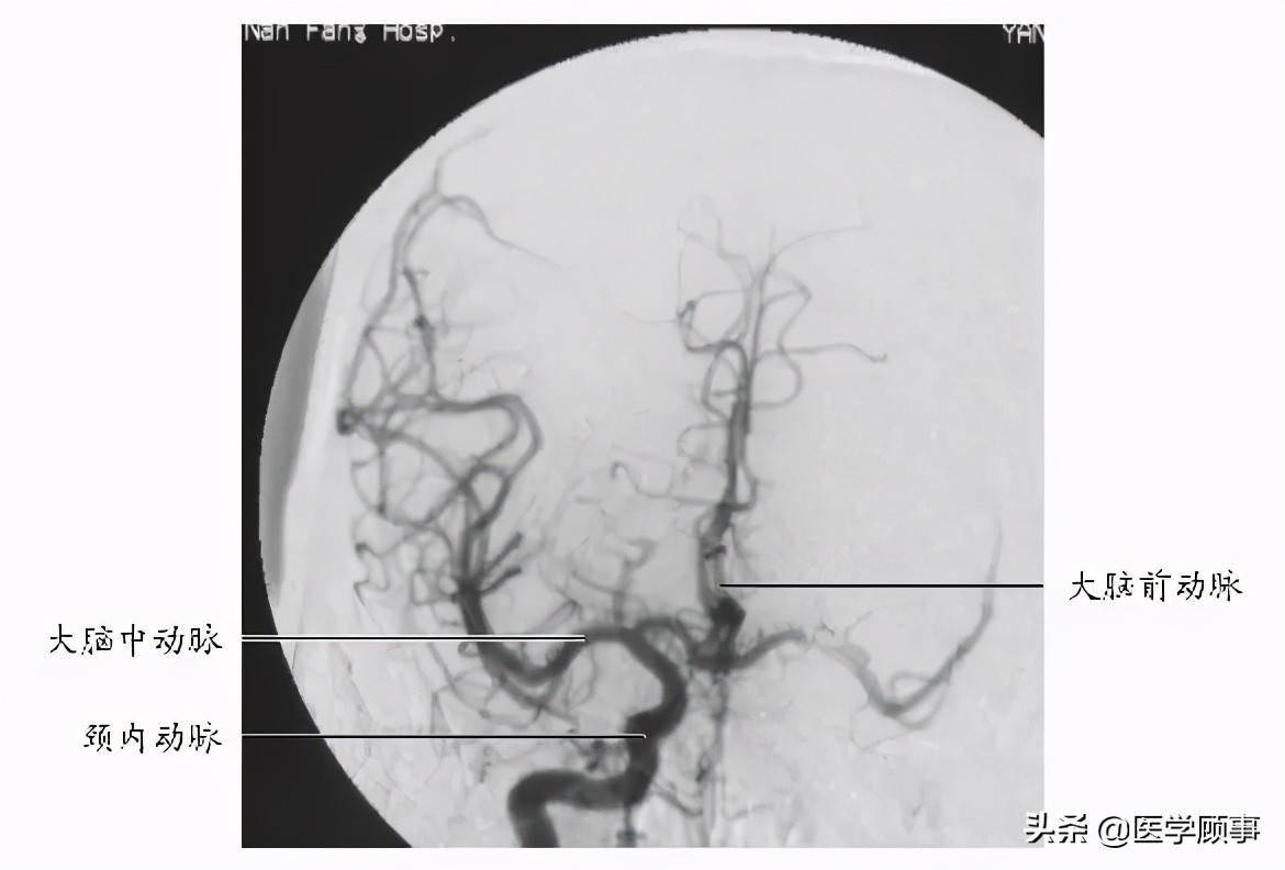 m4大脑中动脉分叉段;m3大脑中动脉侧裂段(外侧沟段m2