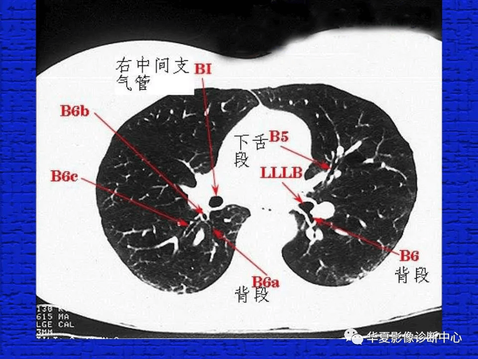 正常肺部ct图解图片
