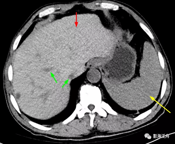 肝脏弥漫性病变的诊断