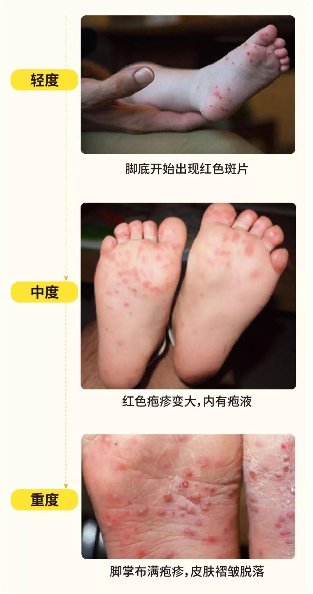 脚上出现红点什么原因 f91de6a79ea14d3f92578a9a0f2e9b79.jpeg