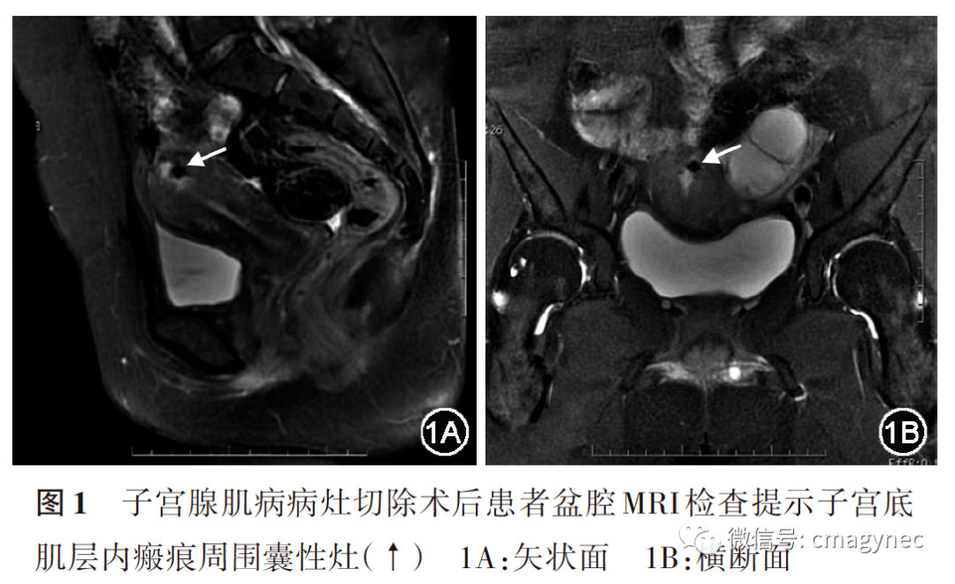 出血量似月經量,無腹痛;查血β‐hcg為157 u/l,盆腔mri檢查提示子宮底