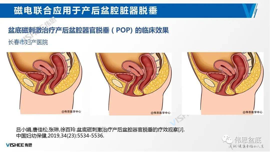 產後腰背痛?陰道突出腫物?別擔心,磁刺激療法來了