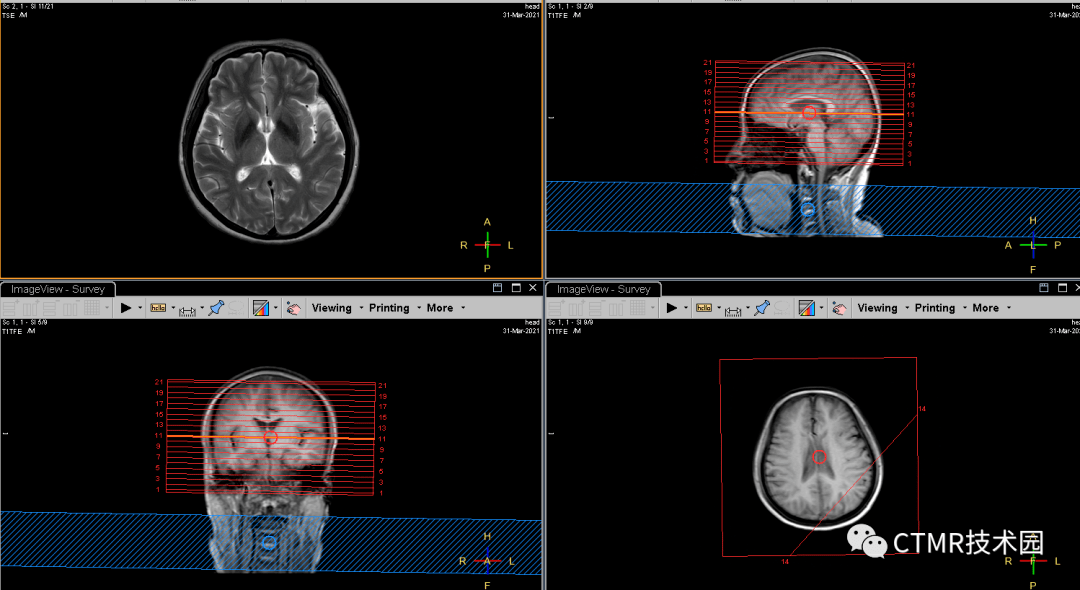 手把手教你基础颅脑mr平扫及后处理