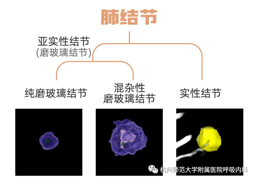 肺部实性结节不能小觑，尤其是这类患者！