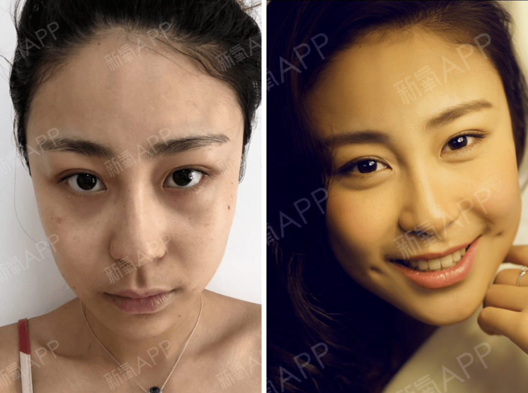 梨涡对面部优化效果竟然那么大