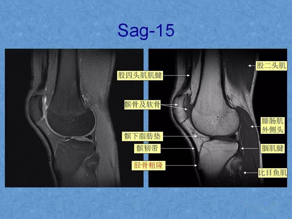 磁共振膝盖片子详解图图片