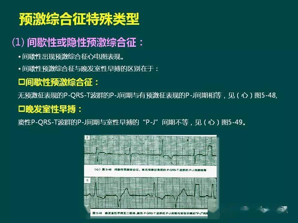 A型预激综合征图片