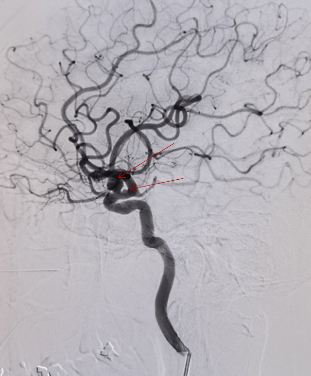 沛嘉加奇嘉介谈丨苏万东tethys03中间导引导管在颈内眼动脉段动脉瘤