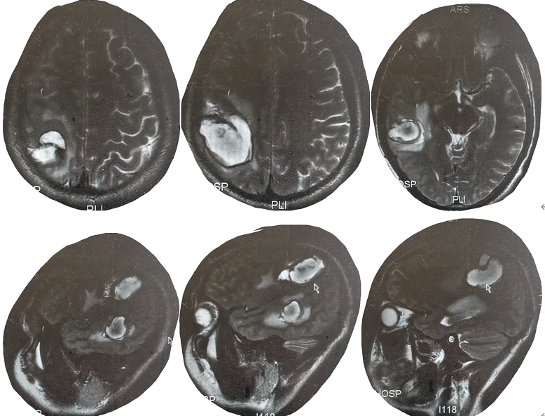 说, 罗某颅脑ct右侧颞顶叶脑出血,右侧颞顶叶脑水肿,左侧肺少量液气胸