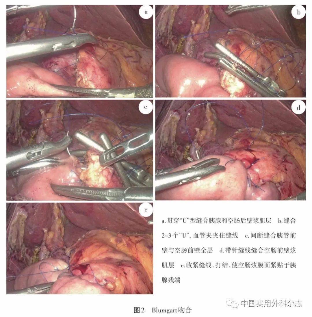 专家共识腹腔镜胰腺外科手术缝合技术与缝合材料选择中