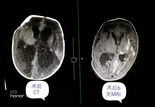 病例分享腦室帽狀腱膜下分流術在腦室內出血後腦積水中的應用心得分享