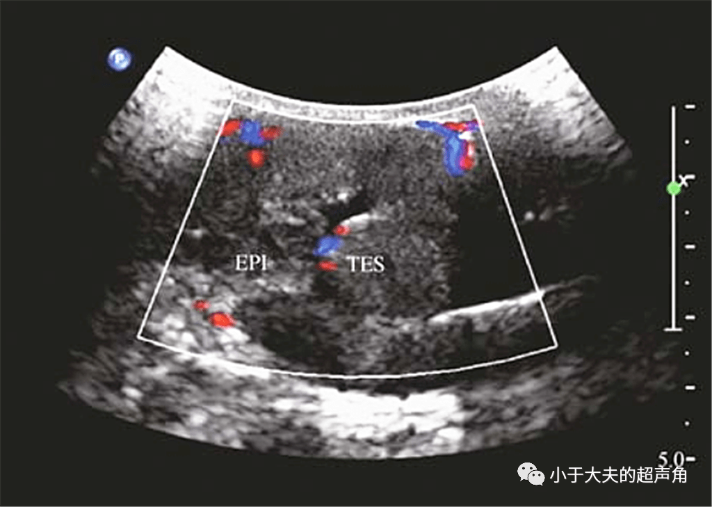 揭秘纤维性假瘤fibrouspseudotumor