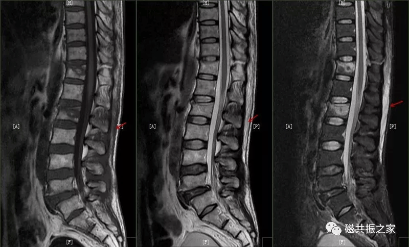 在压脂t2wi图像上棘间韧带信号增高(正常韧带表现为t1wi和t2wi均呈低