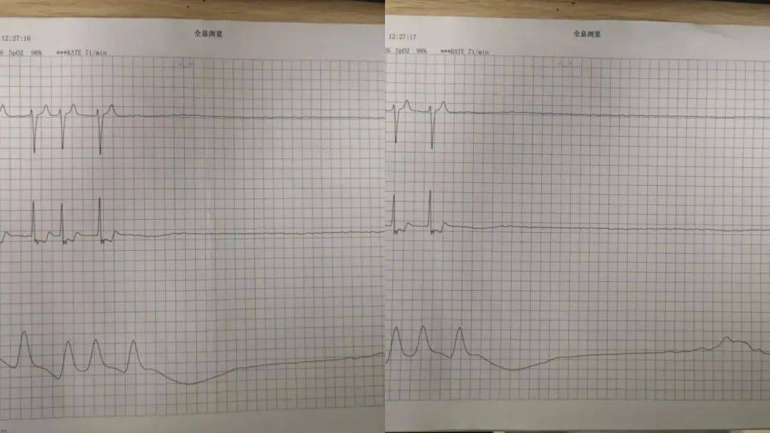 多次心脏骤停,患者命悬一线!普陀的他们当机立断