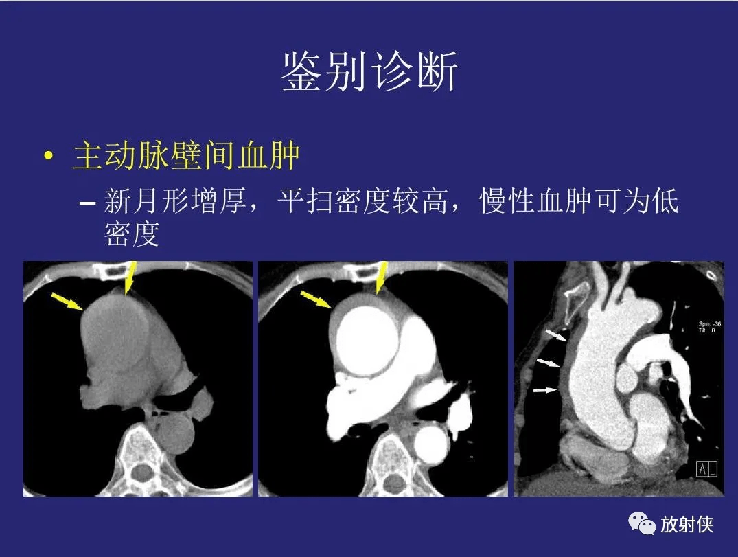 精品大动脉炎分型及ct诊断