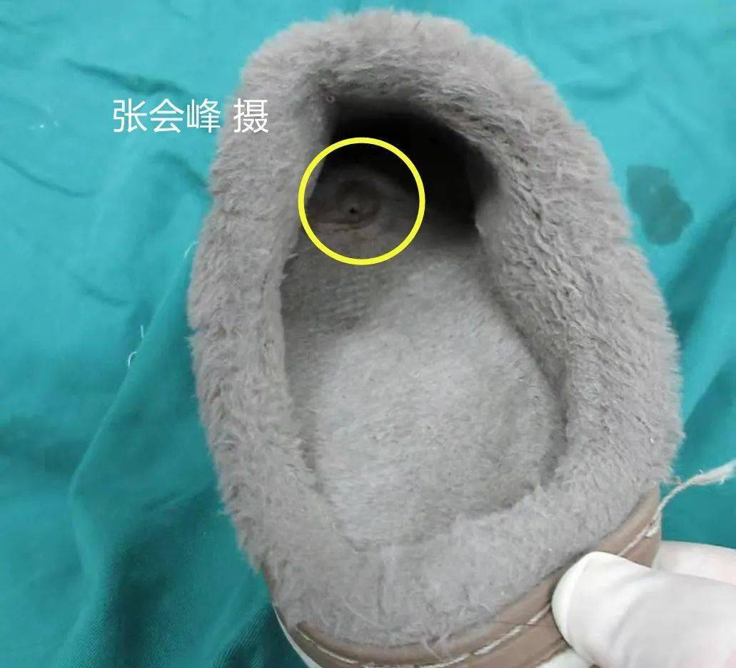 小小螺丝钉因何引发截肢