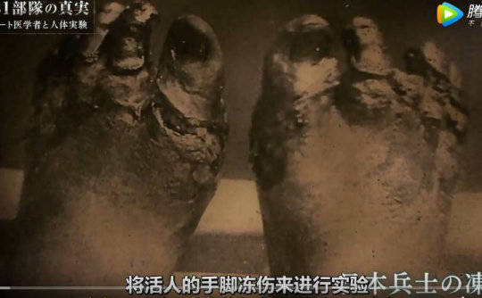 731冰冻实验手只剩骨头图片