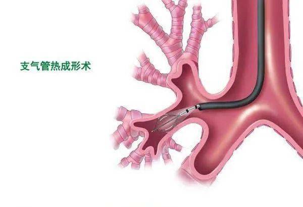 原创
如何治疗难治性哮喘?支气管热成形术了解一下!