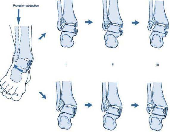 踝关节骨折分型图片图片