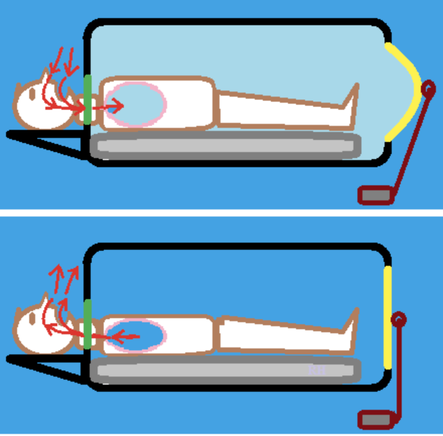 人文67活在柜子里的人从铁肺到呼吸机的诞生