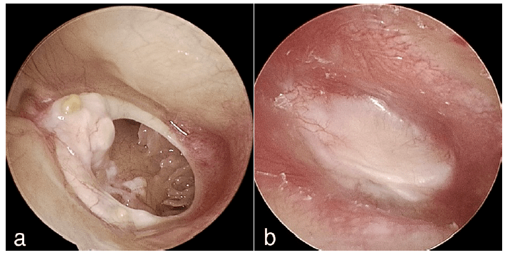 听骨链重建手术成功率图片