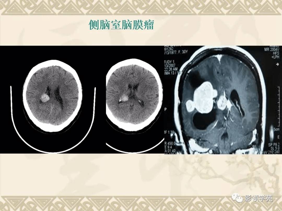 常见脑肿瘤的影像诊断