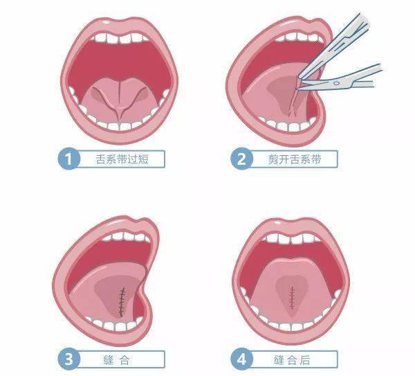 舌系带结构图图片