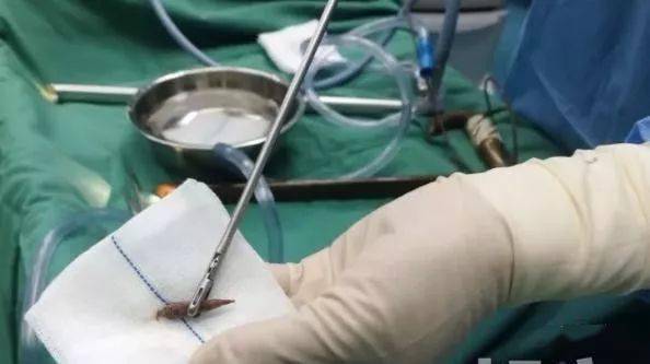 通过喉镜,胃镜已无法取出,不得已在次日接受了开胸手术,一粒枣核让