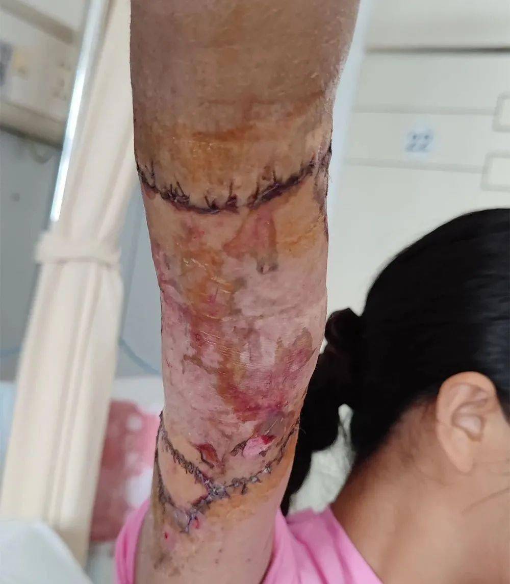 丽医诊事之十三丨六次手术让残臂重生