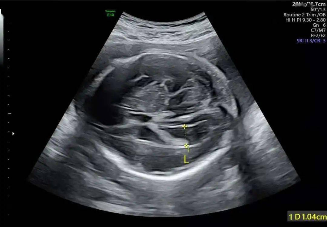 胎儿核磁共振女孩图图片