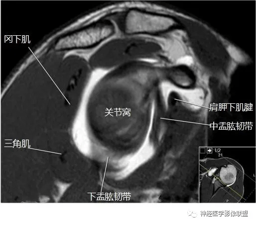 肩关节韧带mri解剖图图片