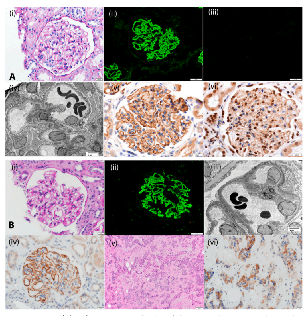 收藏:膜性肾病相关的自身抗原及临床病理特点