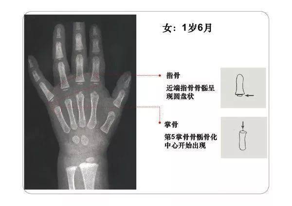 收藏必備丨骨齡圖譜修正版