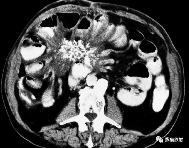 结核性腹膜炎CT图片