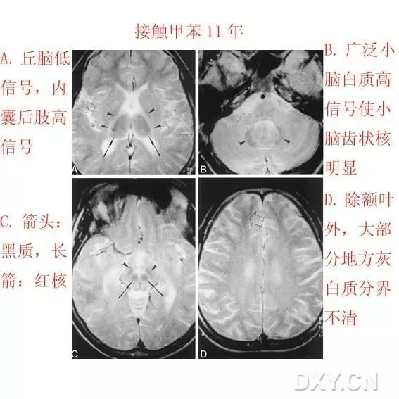 在后颅窝水平