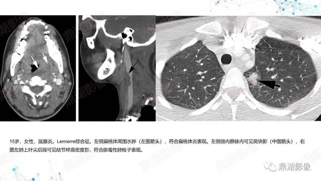 扁桃體炎影像表現會厭炎影像表現右側惡性外耳道炎影像表現閱片的基礎