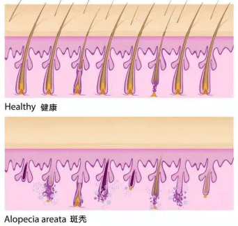 遇上鬼剃头(斑秃),该怎么办?应对方法看这里