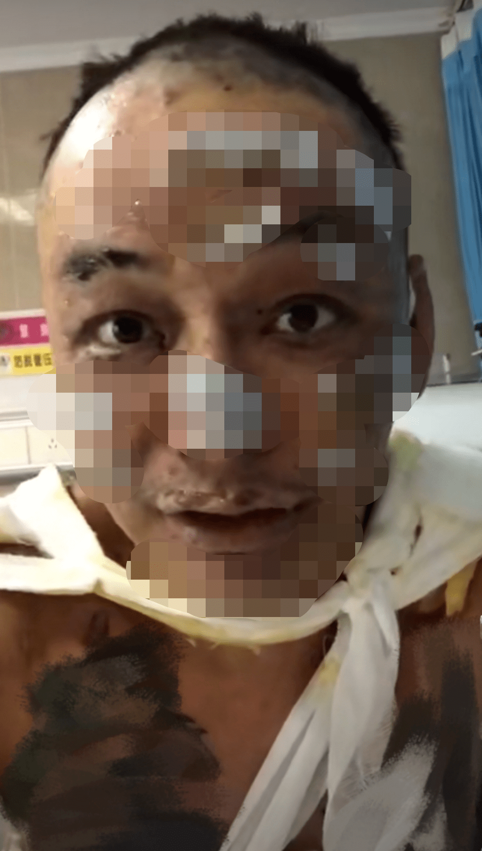 男星被火烧伤险毁容全身40二级深度烧伤受伤照触目惊心