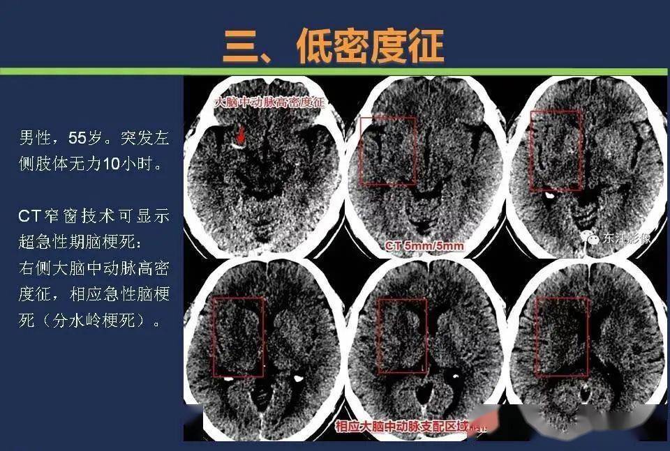 脑梗ct图片解说图讲解图片