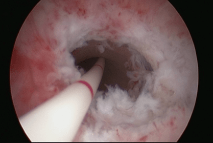 在手术中,医生在内窥镜下发现赵先生的尿道属于重度狭窄,直径才一毫米