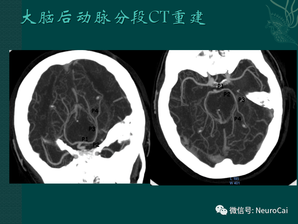 脑ct图片讲解诊断图片