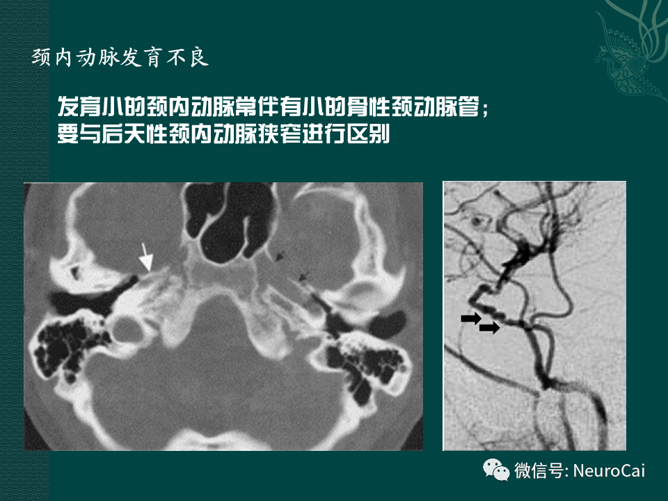 高清圖腦動脈解剖與ct重建