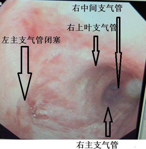 正常人的气管实拍图图片