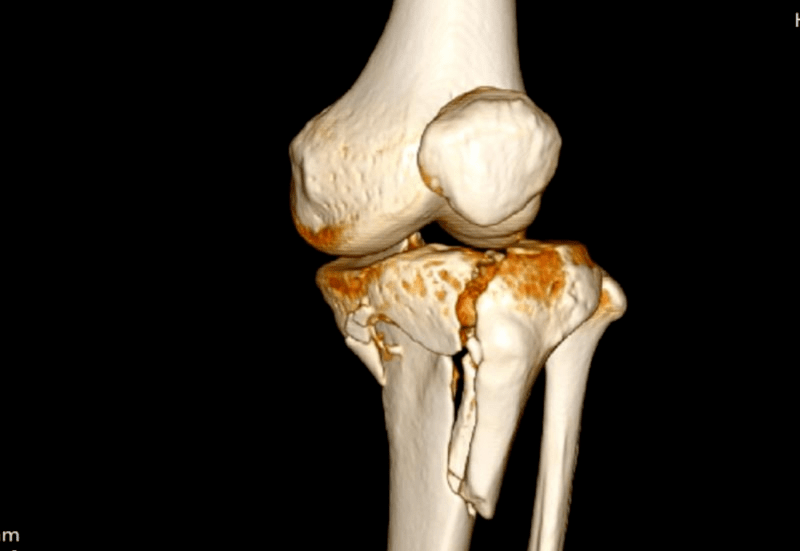 而在胫骨上端以及平台面发生的骨折,就称为胫骨平台骨折