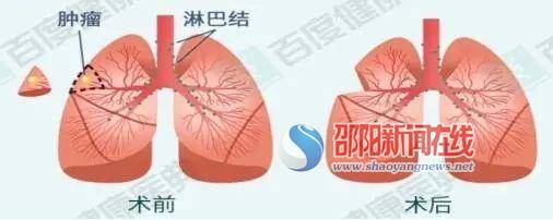 细胞|邵阳市中心医院心胸外科成功完成一例高难度肺癌根治术