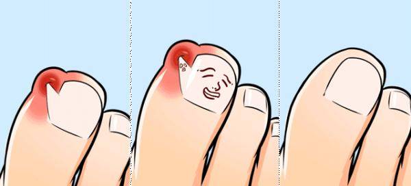 修剪|趾甲没剪对，能让人痛到抓心挠肝撕心裂肺？
