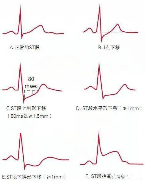 心电图st段图解图片