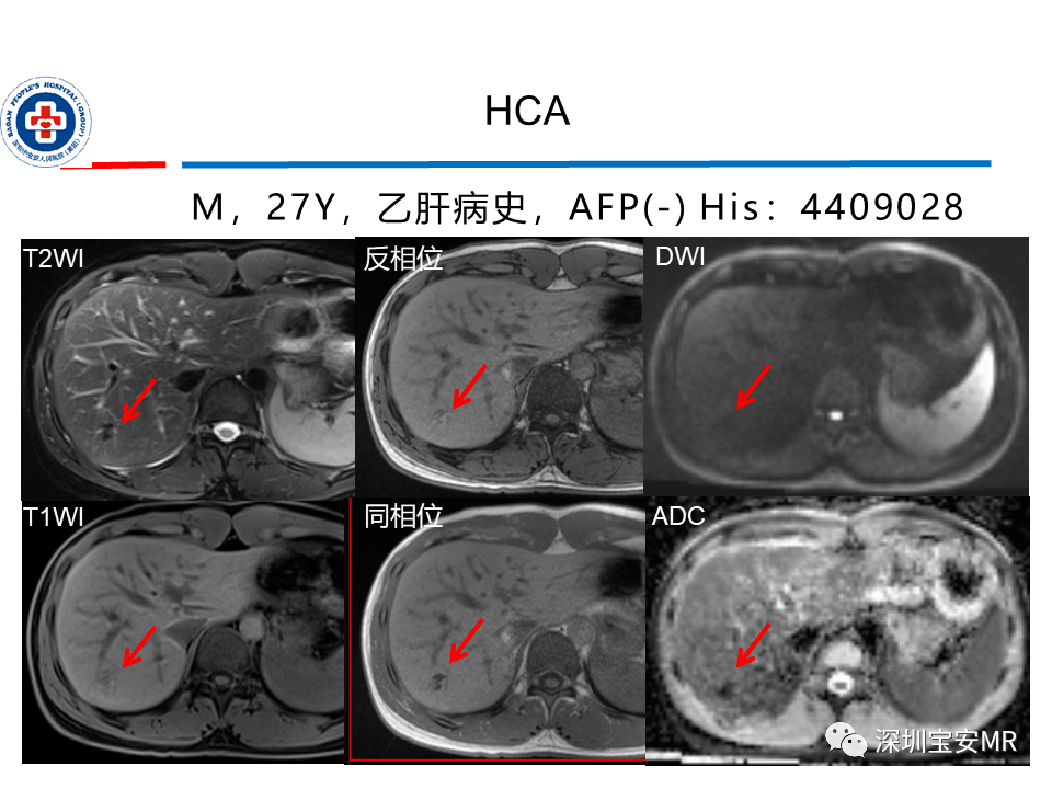 肝脏常见肿瘤mri诊断与鉴别诊断