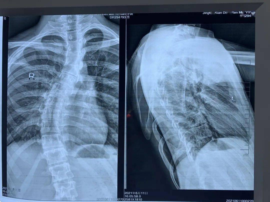 我为群众办实事困扰18岁男孩多年的脊柱侧弯终于被掰正了