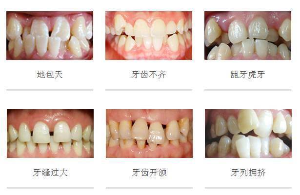 【牙齿矫正】牙齿矫正方法有哪些_牙齿矫正要多久
